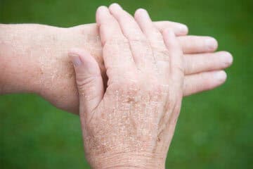 extremely dry hands due to excessive hand sanitizer